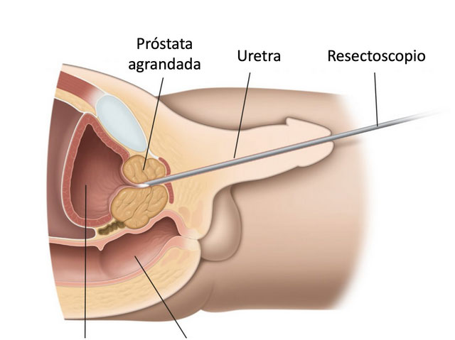 enucleacion-laser