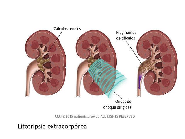 litotripsia-extracorporea