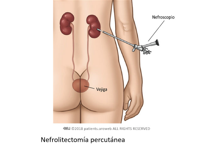 nefrolitectomia-percutanea