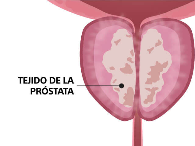 prostata-antes