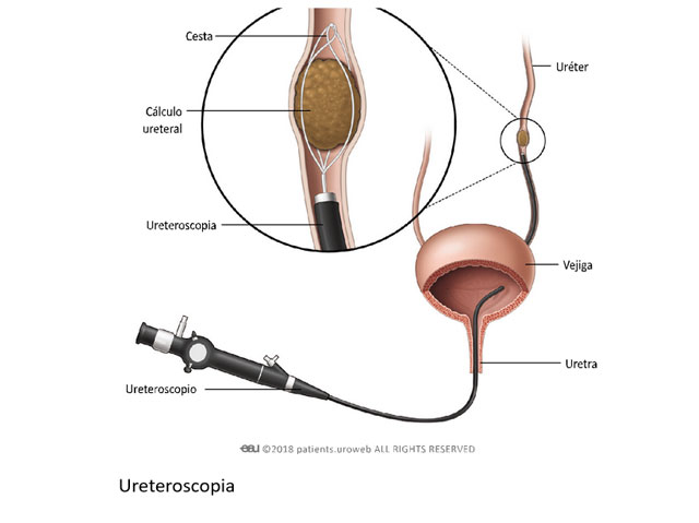 ureteroscopia